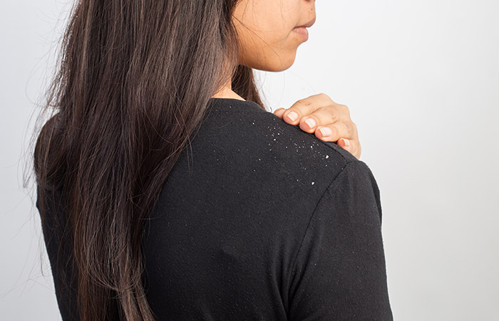 It Helps To Treat Dandruff