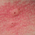 6 Effective Home Remedies For Spider Bites
