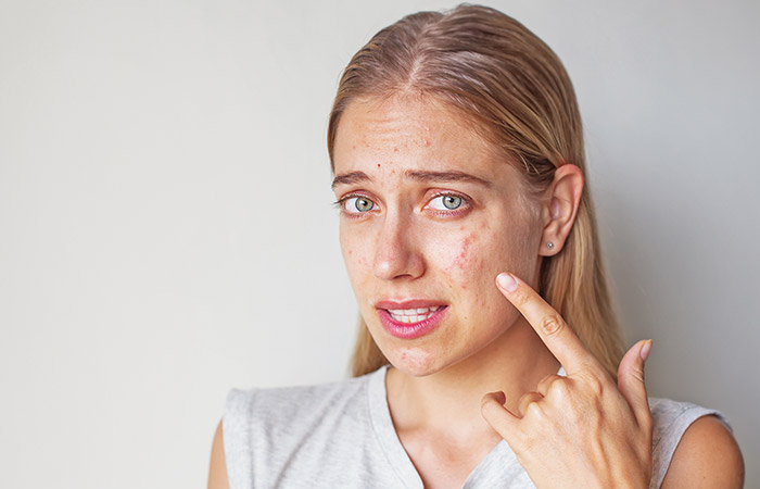 Is Epsom Salt Effective In Treating Acne