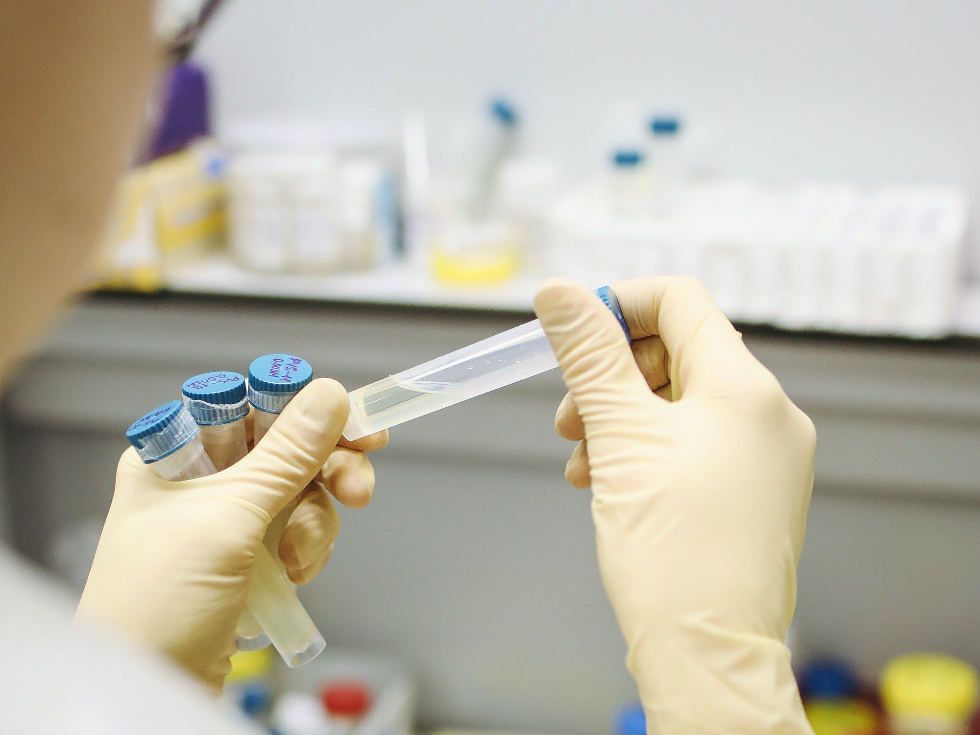 HPV is the most common sexually transmitted infection in the United States.
The new guidelines will prevent 13 percent more cervical cancers and 7 percent more cervical cancer deaths.