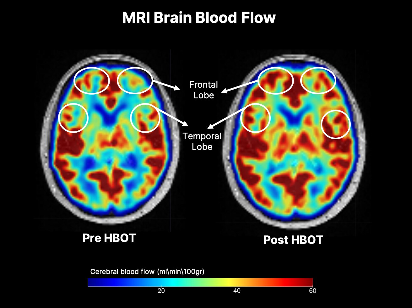 The study results showed an uptick in blood flow and oxygen levels in certain regions after the hyperbaric oxygen therapy.